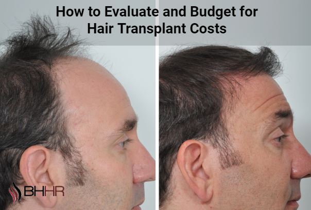 How to Evaluate and Budget for Hair Transplant Costs