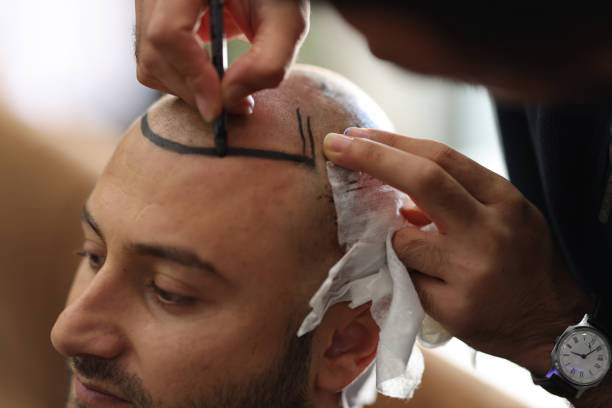 A New Era of Hair Restoration: Hair Transplant Solutions in Riyadh