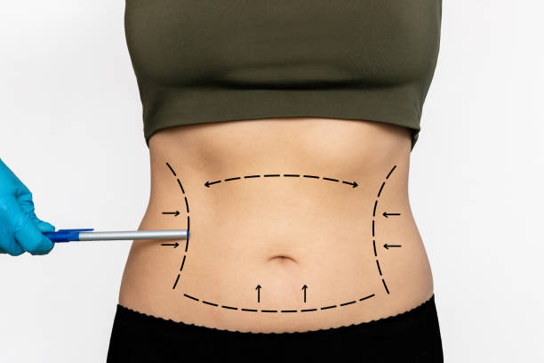 The Art and Science of Liposuction Surgery in Dubai