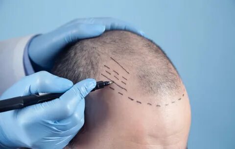 The Hidden Costs of Hair Transplant in Dubai: What to Look For
