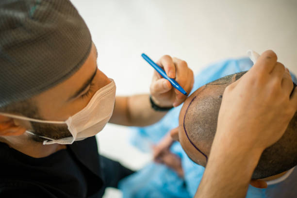 Hair Transplant Scars: Minimizing Visibility in Dubai