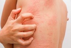 Understanding the Importance of Timely Skin Infections Treatment