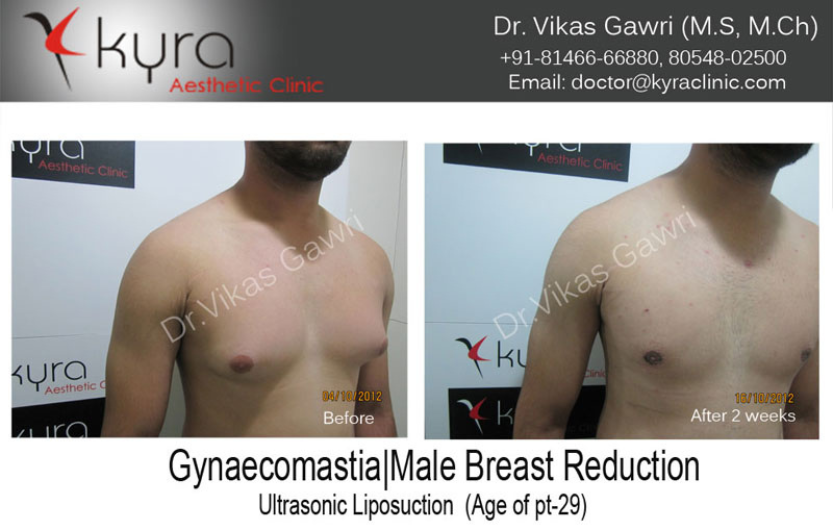 Male Chest Reduction Punjab