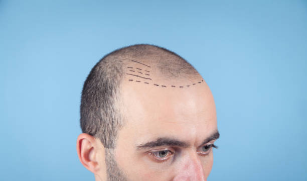 Common Myths About Hair Transplants in Riyadh Debunked