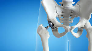 Minimally Invasive Options for Hip and Knee Surgery in Karachi