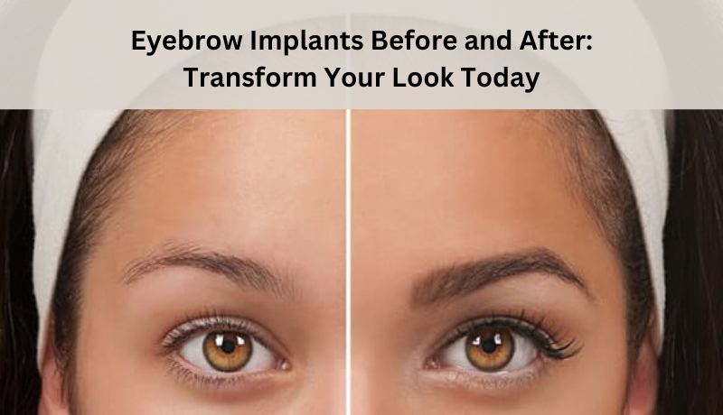 Eyebrow Implants Before and After: Transform Your Look Today