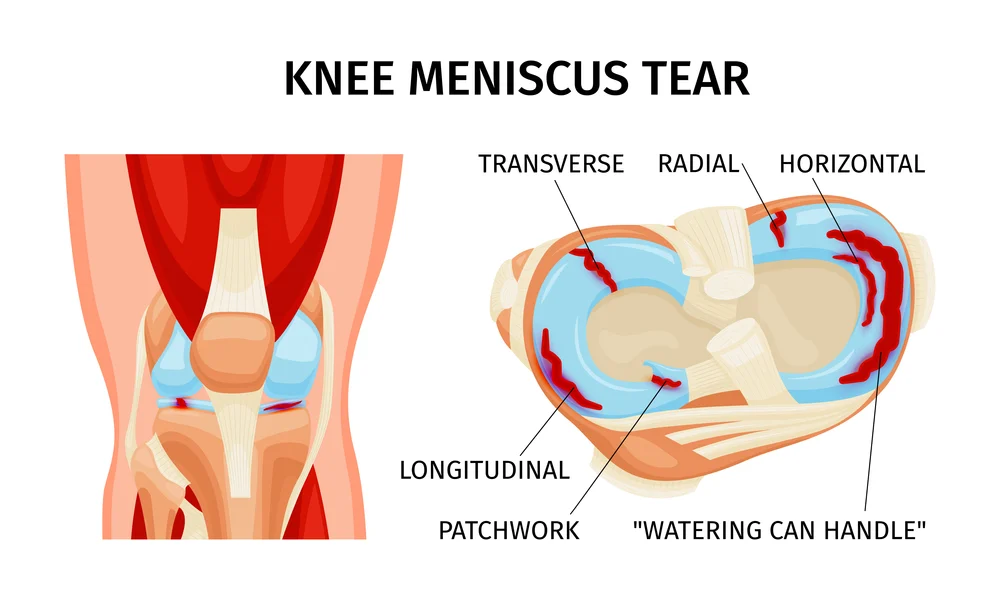 Recovering from a Meniscus Tear: Trust The Cruciates for Expert Care in India