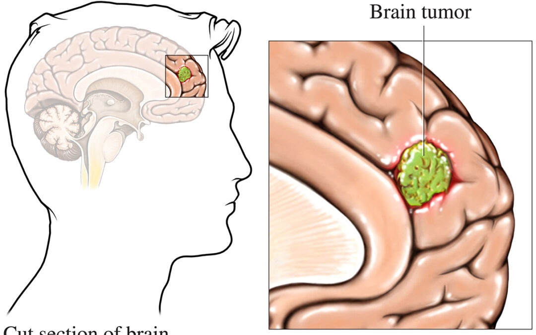 How Long Can Brain Tumors Go Undetected? Understanding Symptoms and Early Diagnosis